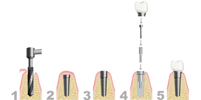 stomatolog warszawa implant