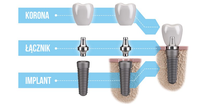 implanty stomatologiczne warszawa