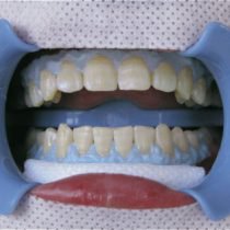 wybielanie zębów krok 3