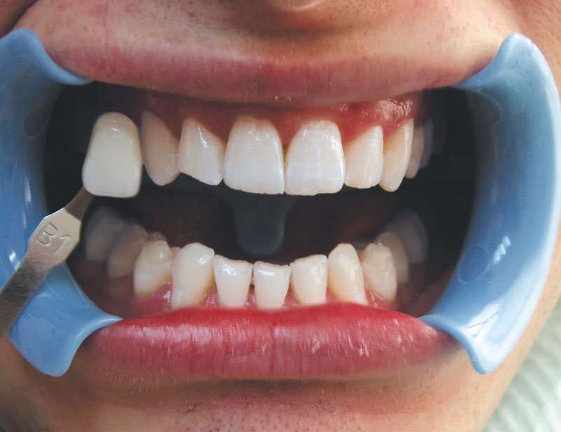 zabieg wybielania zębów metodą beyond efekt po