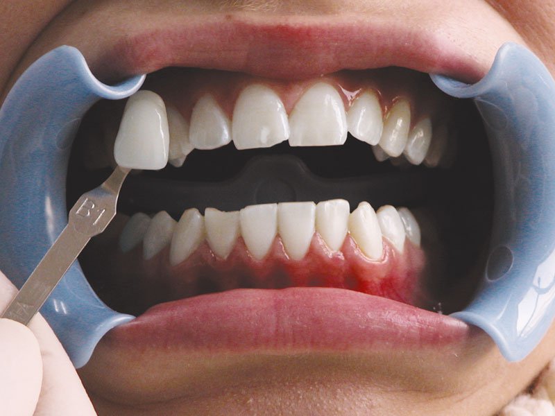 zabieg wybielania zębów metodą beyond efekt po